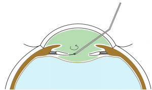 Handmade posterior capsulorhexis.png