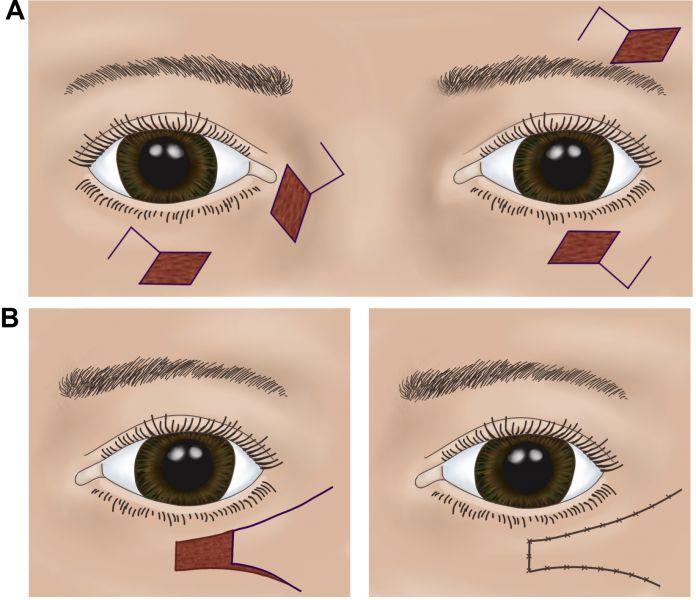 File:Lower Lid Defects and Repair.jpg