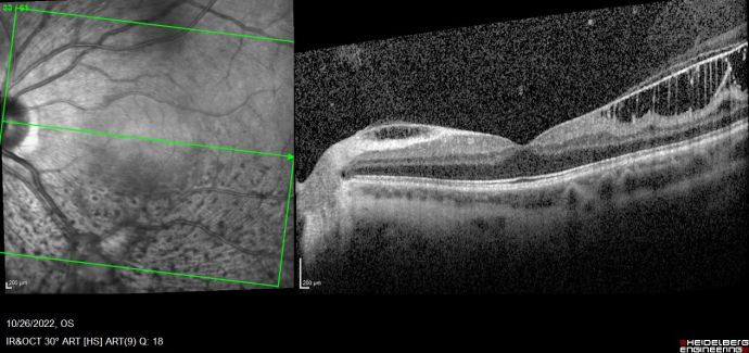 Internal Limiting Membrane Dystrophy (ILMD) - EyeWiki