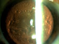 Lattice corneal dystrophy (LCD) is an inherited disorder of the eye characterized by the deposition of amyloid resulting in steadily progressive loss of vision. These deposits create linear, “lattice-like” opacities arising primarily in the central cornea, while the peripheral cornea is often spared. They are radially oriented and are accompanied by gradual, superficial opacification of the cornea. Recurrent epithelial erosions are often present, causing ocular irritation and additional vision loss.