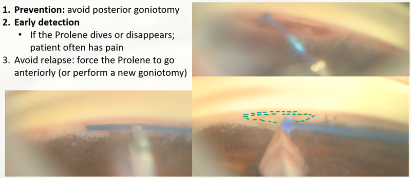 File:Fig.14 avoid suprachor.png