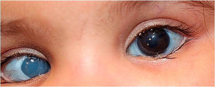 Sanjad-Sakati Syndrome - EyeWiki