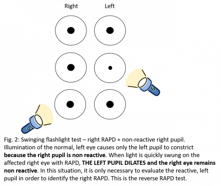 Reverse Relative Afferent Pupillary Defect (RAPD) - EyeWiki