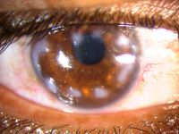 Salzmann’s nodular degeneration