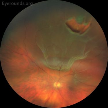 Retinal Detachment - EyeWiki