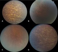 Numerous yellow, drusen-like extramacular deposits were present in the retinal mid-periphery of all affected family members.