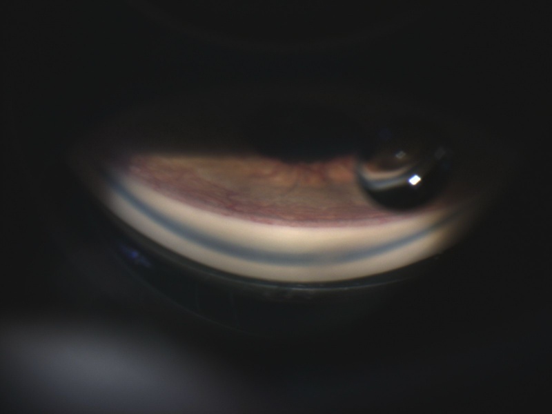 File:Neovascularization of the Angle.jpg