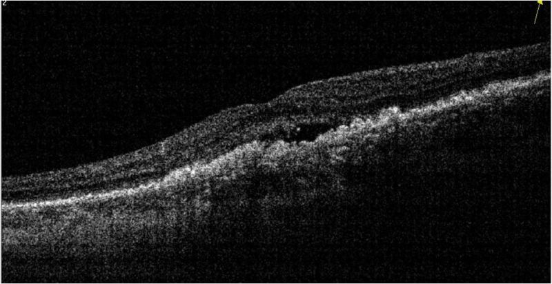 File:Subretinal hyperreflectivity.jpg