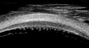 Transverse UBM with probe at limbus .jpg
