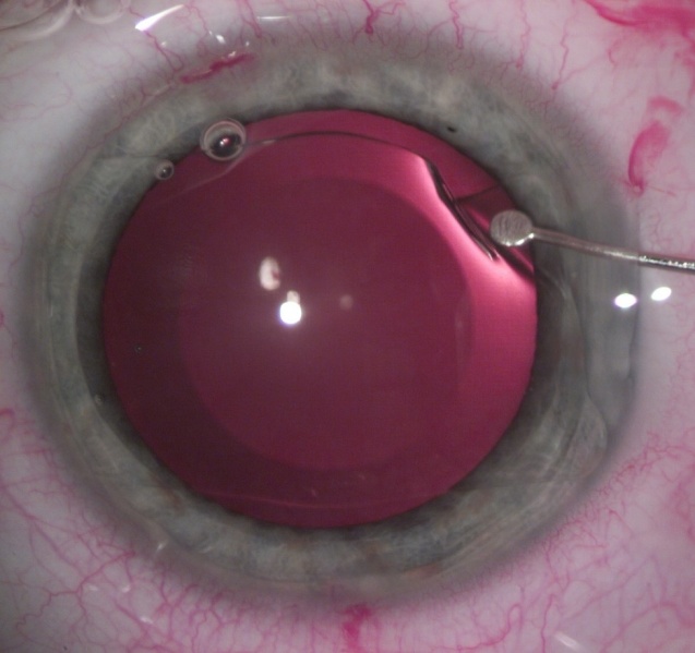 File:Visian ICL insertion technique.JPG