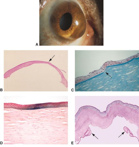 File:AAO keratoconus hydrops pathology.jpg