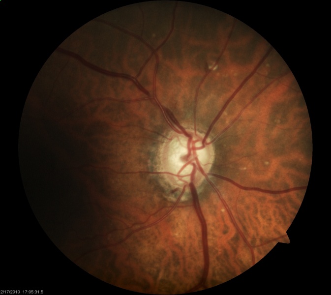 File:Disc hemorrhage.jpg