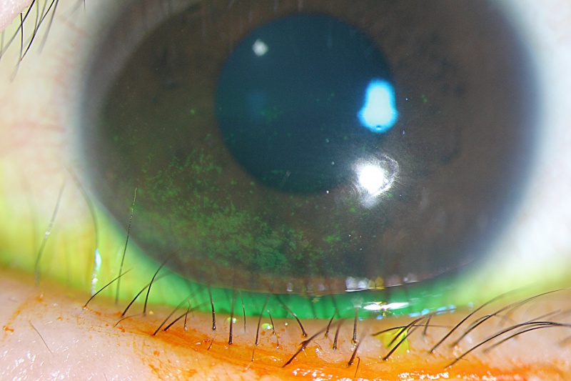 File:Fig 3a. Moderate keratopathy.jpg