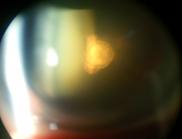 Cataract - EyeWiki