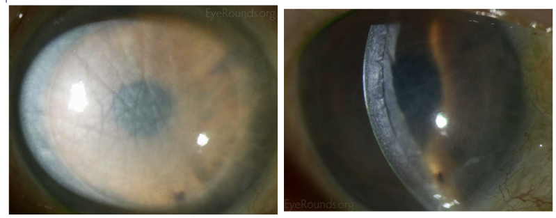 File:DSAEK allograft rejection.png