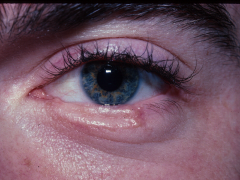 File:Post op Hughes.png