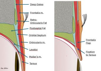 Image depicting the sagittal anatomy of the upper lid and brow before and after FM advancement