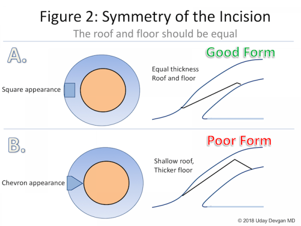 Posterior Capsular Rent - EyeWiki