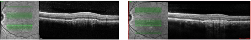 File:Macular I CNV 3.png