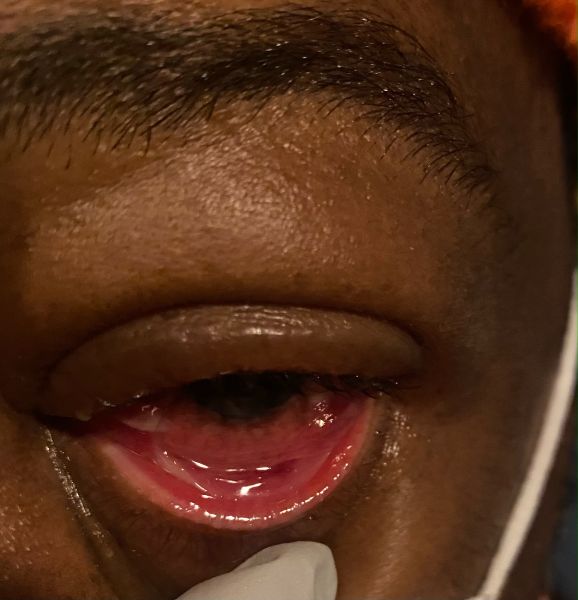 File:Membranous Conjunctivitis.jpg