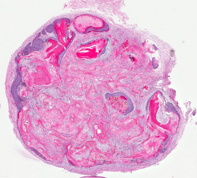 File:Pilomatrixoma.jpeg
