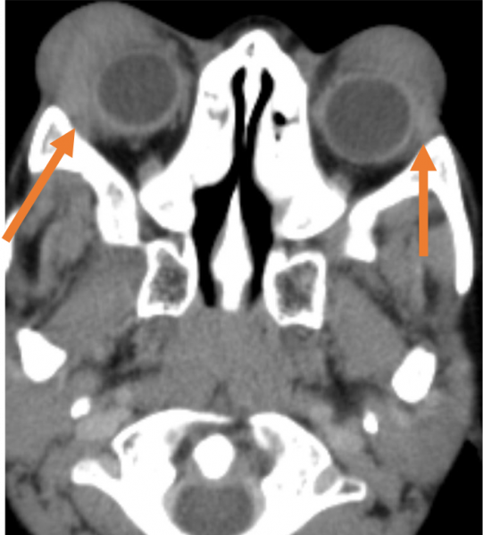 File:Sarcoidosis disease.png
