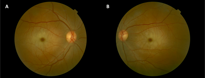File:Cherry Red Spot.png