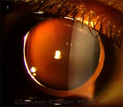 File:Edge-of-Microspherophakic-Lens.webp - EyeWiki