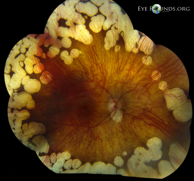 File:Gyrate Atrophy.png