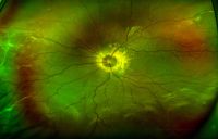 Morning glory syndrome with serous retinal detachment. Enlarged and funnel-shaped excavation of right optic disc with hyperplastic glial tissues in the central disc, peripapillary pigment abnormality, multiple anomalous straight vessels radiating circumferentially from the optic disc, inferior serous retinal detachment from 3 to 9 o'clock.