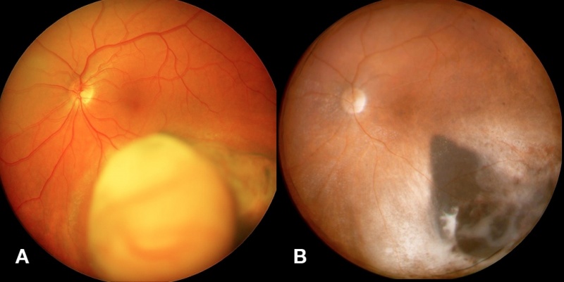 File:Fig03 eyewiki.jpg