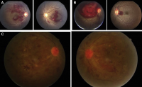 A, Fundus photograph of a patient with acute lymphoid leukemia, showing multiple Roth spots, superficial and deep hemorrhages, and a subhyaloid bleed involving the macula. B, Fundus photograph of a patient with acute myeloid leukemia, showing dilated tortuous vessels, multiple Roth spots,and a ubhyaloid bleed in the right eye. C, Fundus photograph of a patient with chronic myeloid leukemia with bilateral disc and macular edema, cotton wool spots, Roth spots, retinal infiltrates, and neovascularization of the disc and elsewhere