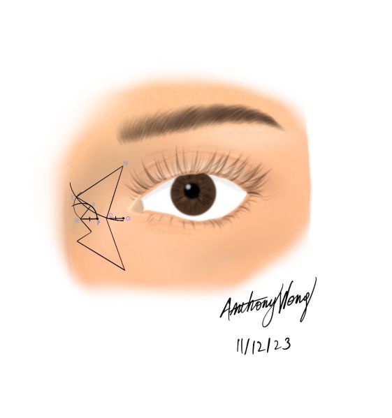 File:V-W Medial Canthoplasty.jpg