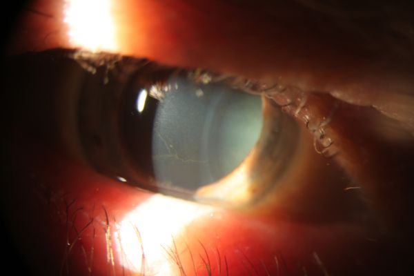 cornea-verticillata-eyewiki