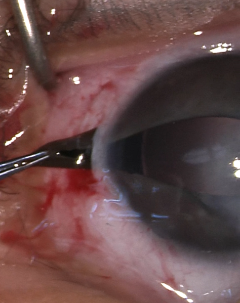 File:Peters Optical Iridectomy.png