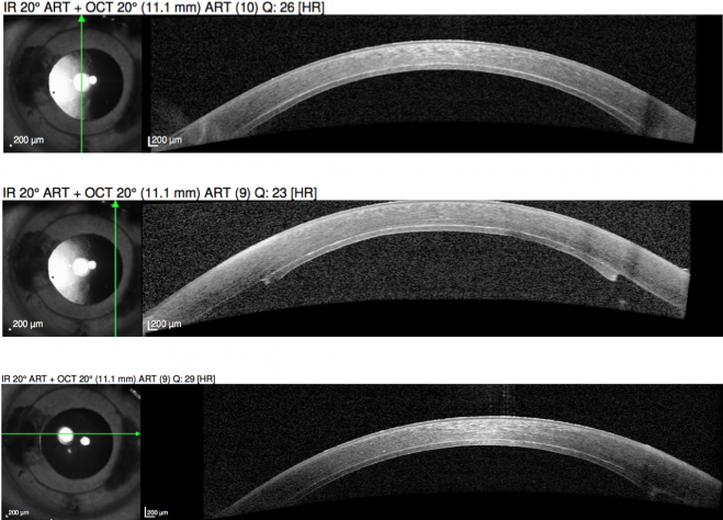 Descemet Stripping Endothelial Keratoplasty - EyeWiki