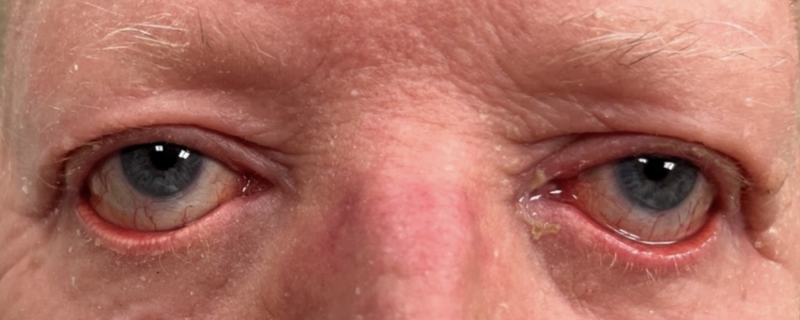 File:External photo eyes PRP.png