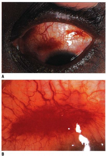 File:Multiple kaposi sarcoma lesions.jpg