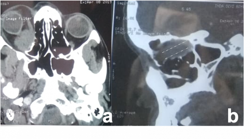 File:Optic nerve sheath meningioma.png