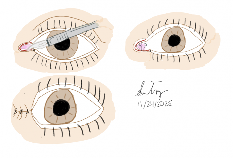 File:Permanent Medial Tarsorrhaphy.png