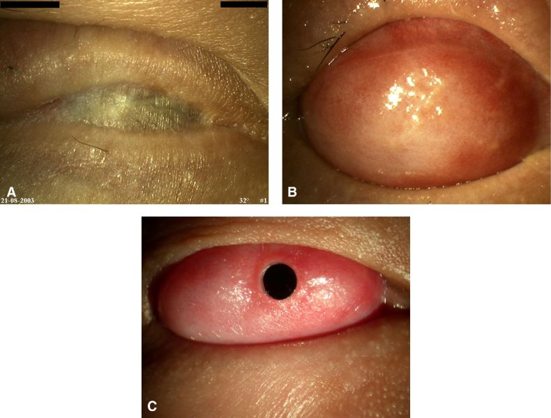 File:Stevens-Johnson syndrome-02.jpg