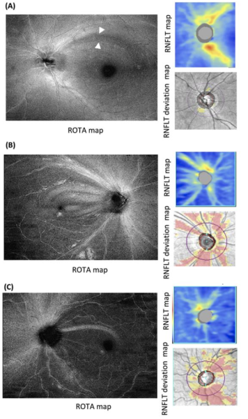 File:ROTA of eye with glaucoma.png