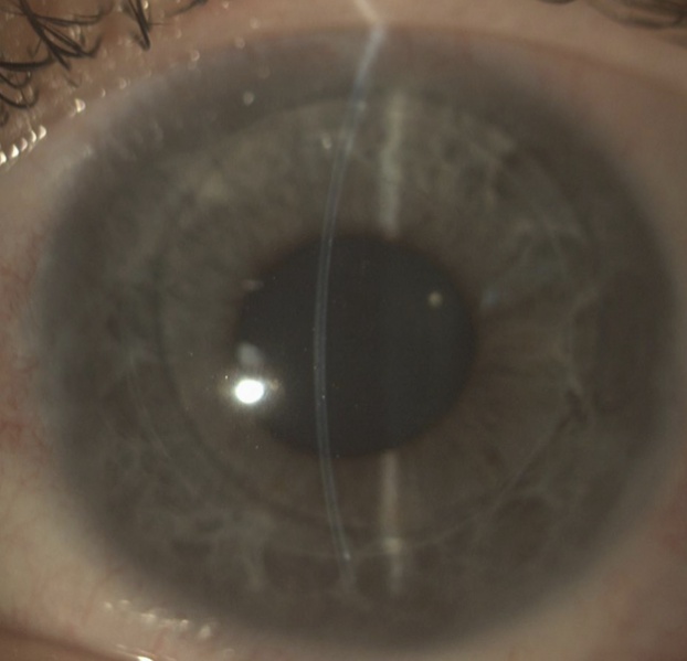 File:DSEK - Slit lamp observation.jpg