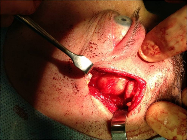File:Lateral Orbitotomy Figure 5.jpg