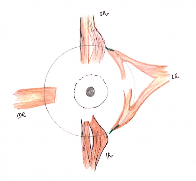 File:Jensen's procedure.jpg