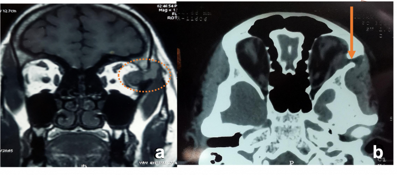 File:Dumbell Dermoid cyst.png