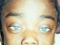 Hurler's syndrome, cloudy corneas