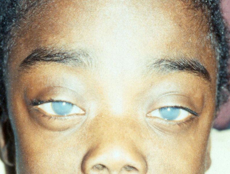 File:Aao img collection hurlers syndrome.jpg