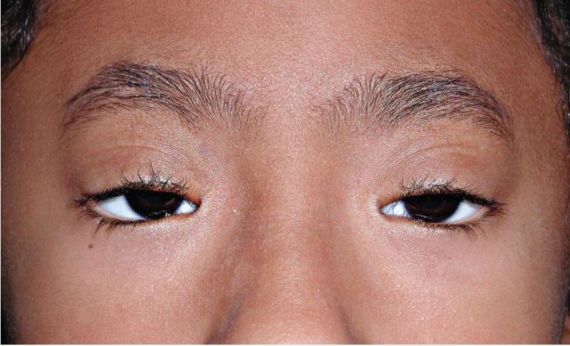 File:Blepharophimosis–ptosis–epicanthus inversus syndrome.jpg