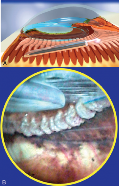 File:ECP.pars.plana.approach.png